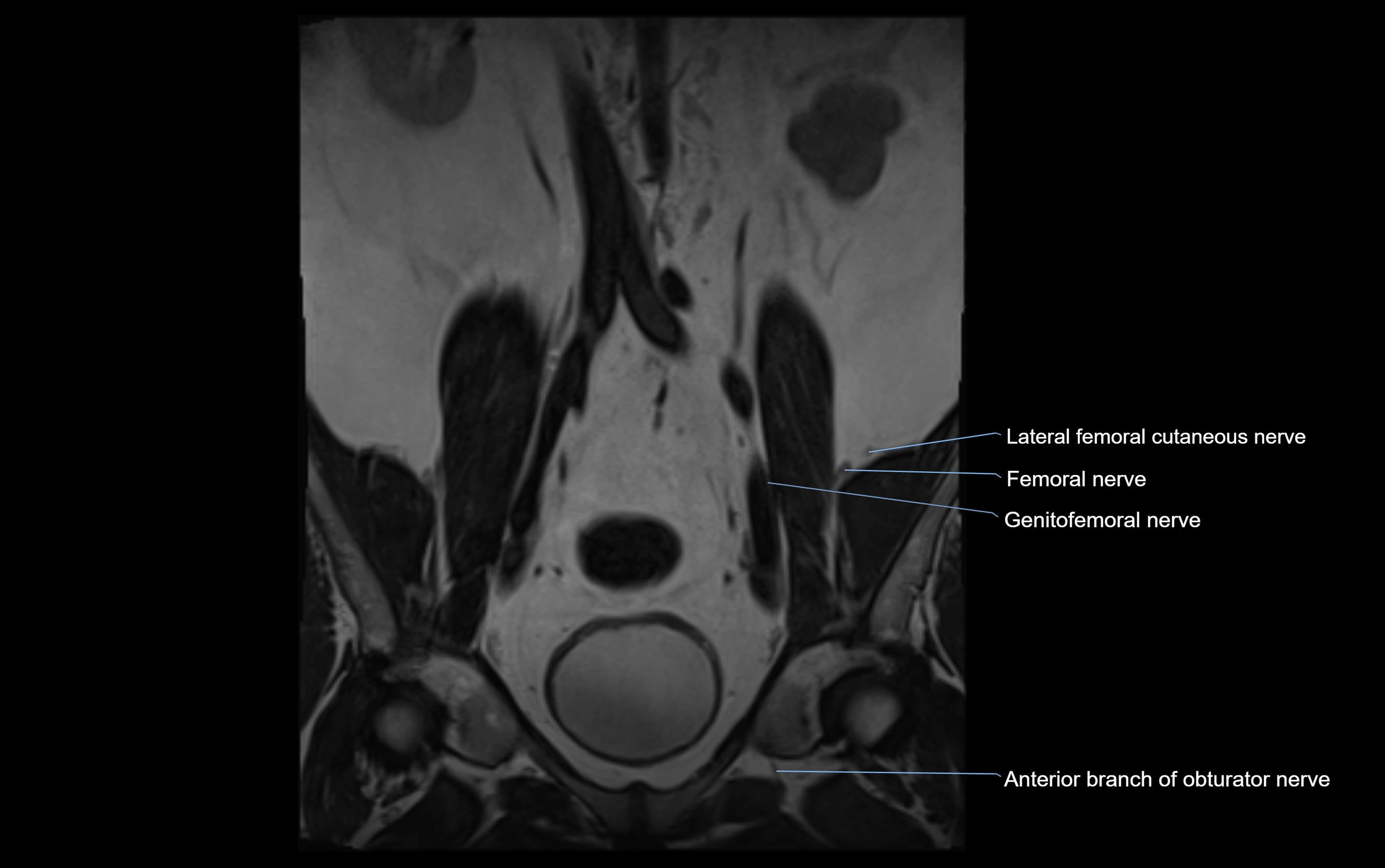 MR lumbosacral plexus cross sectional anatomy 3T  radiology  image-img-09001-00007.webp